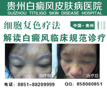贵州哪个地方可以治疗成人白癜风