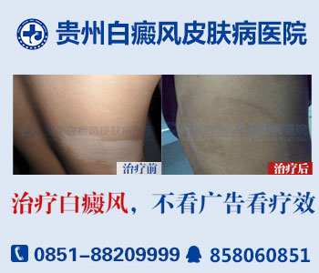 贵州哪个白癜风医院好