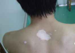 贵阳白癜风哪里治疗好